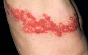 Shingles