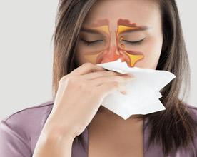 Sinusitis